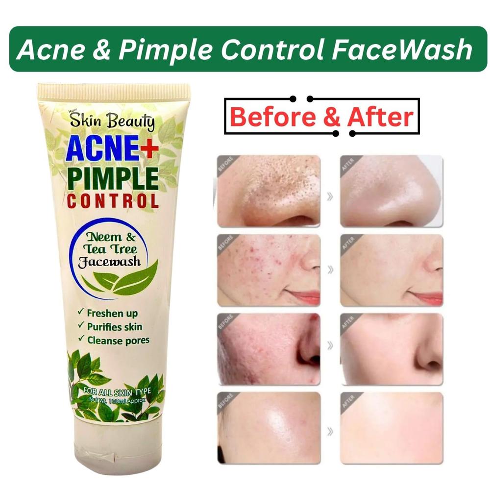 Acne+ Pimple control Best 100% Natural Face Wash , 100 Ml - Fashion Lovers