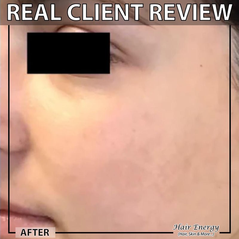 Derma Face Roller, 0.5 mm, Repair Hair Loss - Best Quality - Fashion Lovers