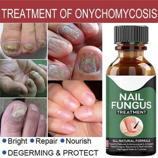 Fast Nail Fungal Treatments Nail Repair - Best Quality - Fashion Lovers