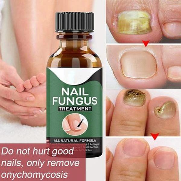 Fast Nail Fungal Treatments Nail Repair - Best Quality - Fashion Lovers
