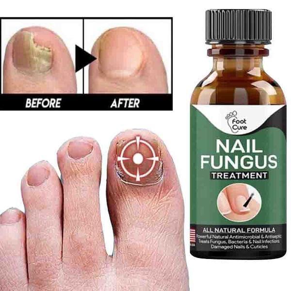 Fast Nail Fungal Treatments Nail Repair - Best Quality - Fashion Lovers